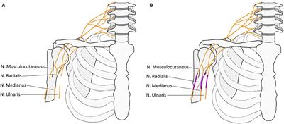 Case Report: Plasticity in Central Sensory Finger Representation and Touch Perception After Microsurgical Reconstruction of Infraclavicular Brachial Plexus Injury